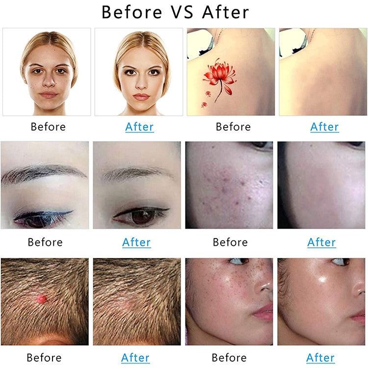 AA-A401 Small Freckle and Mole Removal Pen Tattoo and Eyebrow Removal Beauty Instrument, Color: Red Light Battery - Beauty Instrument by buy2fix | Online Shopping UK | buy2fix