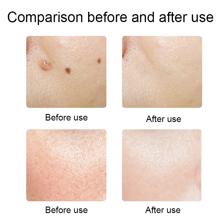 FY-106 Portable Mole and Freckle Removal Pen Household Laser Beauty Equipment(Rose Gold) - Beauty Instrument by buy2fix | Online Shopping UK | buy2fix