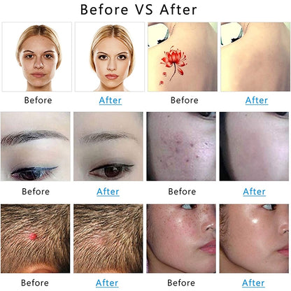 AA-A401 Small Freckle and Mole Removal Pen Tattoo and Eyebrow Removal Beauty Instrument, Color: Blu-ray Battery - Beauty Instrument by buy2fix | Online Shopping UK | buy2fix