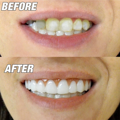 Beauty Tool False Teeth Instant Smile Comfort Fit Flex Fake Tooth Cover - Orthodontic Braces by buy2fix | Online Shopping UK | buy2fix
